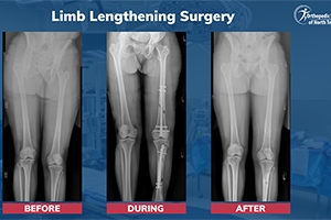 Common Questions About Limb Lengthening Surgery: Procedure, Recovery & Risks