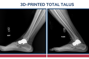 What Patients Should Know About 3D-Printed Total Talus and Avascular Necrosis