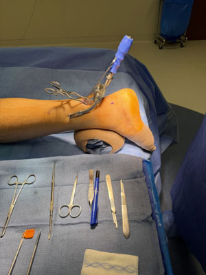Achilles Tendon Rupture: Boot or Surgery?