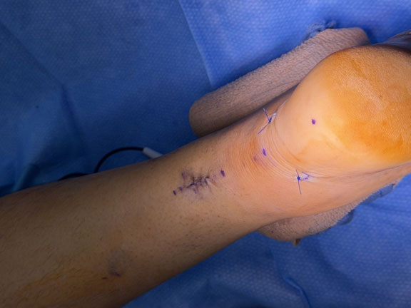 Achilles Tendon Rupture: Boot or Surgery?
