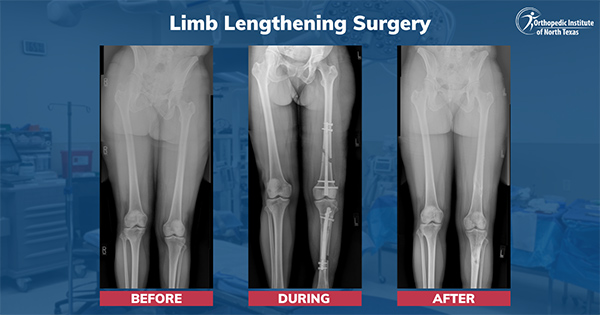 Common Questions About Limb Lengthening Surgery: Procedure, Recovery & Risks