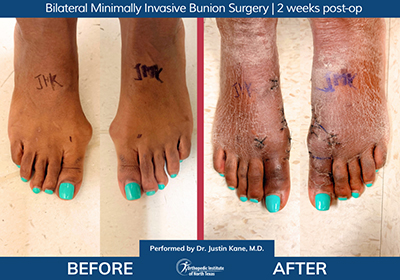 Bilateral Minimally Invasive Bunion Surgery - Performed by Dr. Justin Kane at OINT