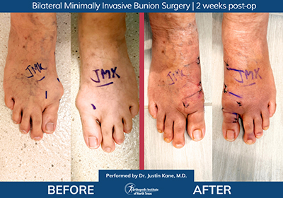 Bilateral Minimally Invasive Bunion Surgery - Performed by Dr. Justin Kane at OINT