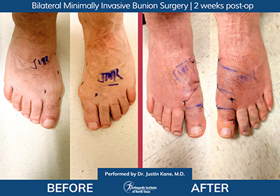 Bilateral Minimally Invasive Bunion Surgery - Performed by Dr. Justin Kane at OINT