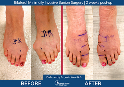 Bilateral Minimally Invasive Bunion Surgery - Performed by Dr. Justin Kane at OINT