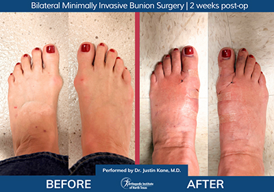 Bilateral Minimally Invasive Bunion Surgery - Performed by Dr. Justin Kane at OINT