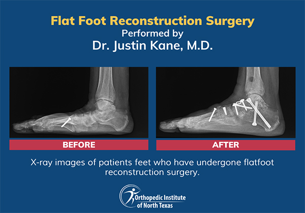 X-ray images of patients feet who have undergone flatfoot reconstruction surgery.