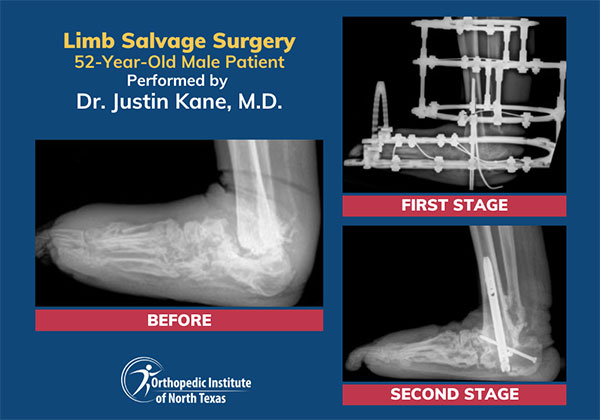 Before and after of a successful limb salvage procedure for a 52-year-old patient performed by Dr. Justin Kane, M.D.