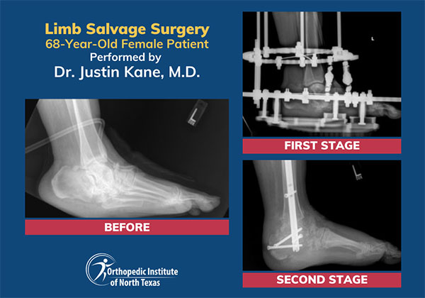 Before and after of a successful limb salvage surgery performed by Dr. Justin Kane, M.D. on a 68-year-old patient.
