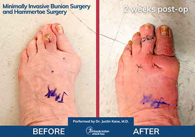 Minimally Invasive Bunion Surgery Bilateral - Performed by Dr. Justin Kane at OINT