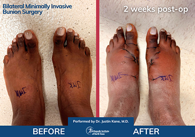 Minimally Invasive Bunion Surgery Bilateral - Performed by Dr. Justin Kane at OINT