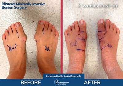 Minimally Invasive Bunion Surgery Bilateral - Performed by Dr. Justin Kane at OINT