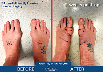 Minimally Invasive Bunion Surgery Bilateral - Performed by Dr. Justin Kane at OINT