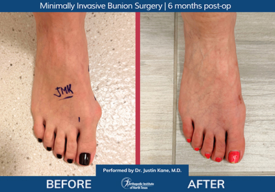 Minimally Invasive Bunion Surgery Bilateral - Performed by Dr. Justin Kane at OINT