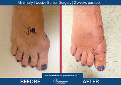 Minimally Invasive Bunion Surgery Bilateral - Performed by Dr. Justin Kane at OINT