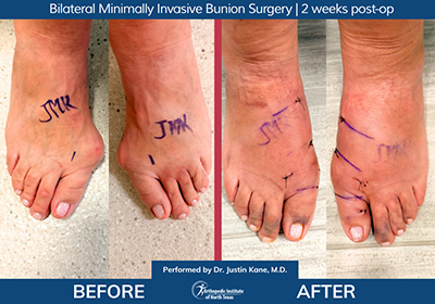Minimally Invasive Bunion Surgery Bilateral - Performed by Dr. Justin Kane at OINT