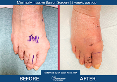 Minimally Invasive Bunion Surgery Bilateral - Performed by Dr. Justin Kane at OINT