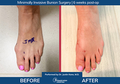 Minimally Invasive Bunion Surgery Bilateral - Performed by Dr. Justin Kane at OINT