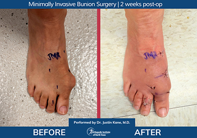 Minimally Invasive Bunion Surgery Bilateral - Performed by Dr. Justin Kane at OINT