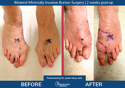 Minimally Invasive Bunion Surgery Bilateral - Performed by Dr. Justin Kane at OINT