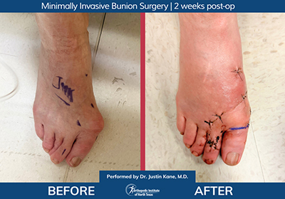 Minimally Invasive Bunion Surgery Bilateral - Performed by Dr. Justin Kane at OINT
