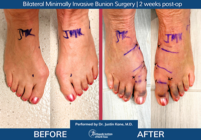 Minimally Invasive Bunion Surgery Bilateral - Performed by Dr. Justin Kane at OINT