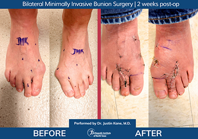 Minimally Invasive Bunion Surgery Bilateral - Performed by Dr. Justin Kane at OINT