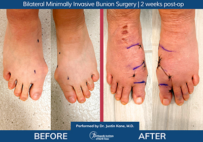 Minimally Invasive Bunion Surgery Bilateral - Performed by Dr. Justin Kane at OINT