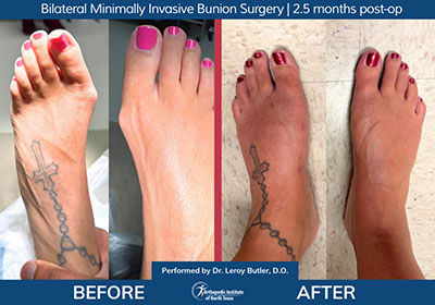 Minimally Invasive Bunion Surgery Bilateral - Performed by Dr. Justin Kane at OINT