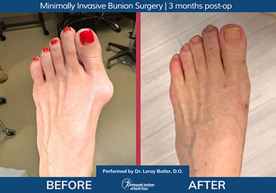 Minimally Invasive Bunion Surgery Bilateral - Performed by Dr. Justin Kane at OINT