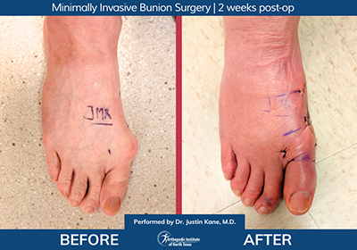 Minimally Invasive Bunion Surgery - Performed by Dr. Justin Kane at OINT