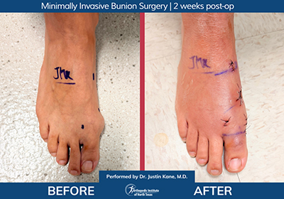 Minimally Invasive Bunion Surgery - Performed by Dr. Justin Kane at OINT