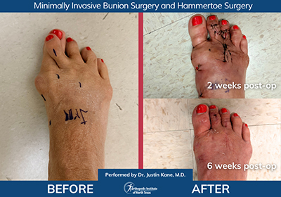 Minimally Invasive Bunion Surgery - Performed by Dr. Justin Kane at OINT