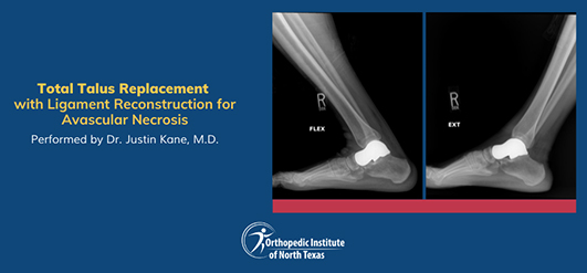 3D Printed Total Talus Replacement in Frisco, TX