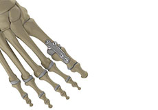 1st MTP Fusion (Arthrodesis)