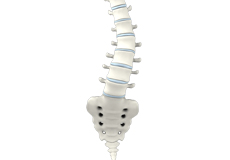 Adult Degenerative Scoliosis