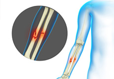 Adult Forearm Fractures