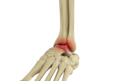 Ankle Arthritis