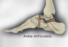 Ankle Arthrodesis