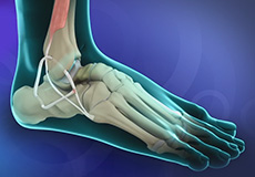 Ankle Ligament Reconstruction