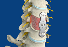 Anterior Cervical Corpectomy and Fusion