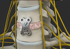 Anterior Cervical Discectomy with Fusion