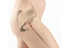 Anterior Hip Replacement