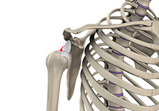 Acromioclavicular (AC) Joint Arthritis  North Texas Orthopedics & Spine  Center