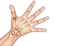 Arthritis of the Hand and Wrist