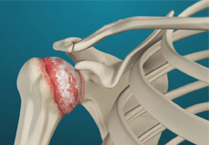 Arthritis Of The Shoulder