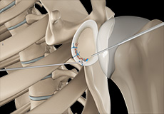 Arthroscopic Bankart Repair