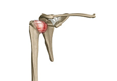 Arthroscopic Frozen Shoulder Release