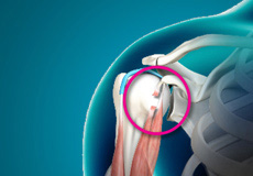 Bicep Tendon Rupture