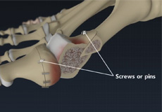 Hammertoe